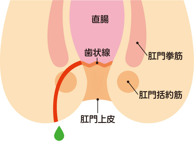 痔ろう