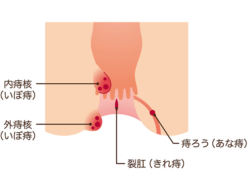 痔