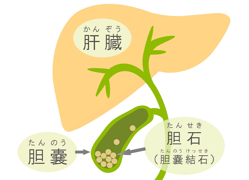 胆石症について