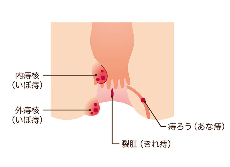 痔について